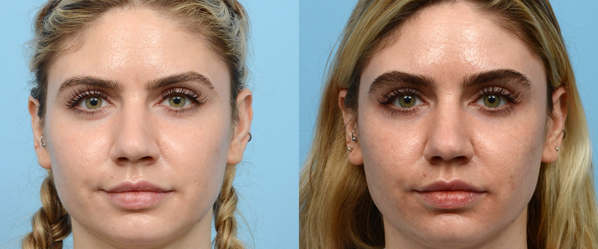 Where to Find Morpheus8 for Non-Surgical Skin Rejuvenation
