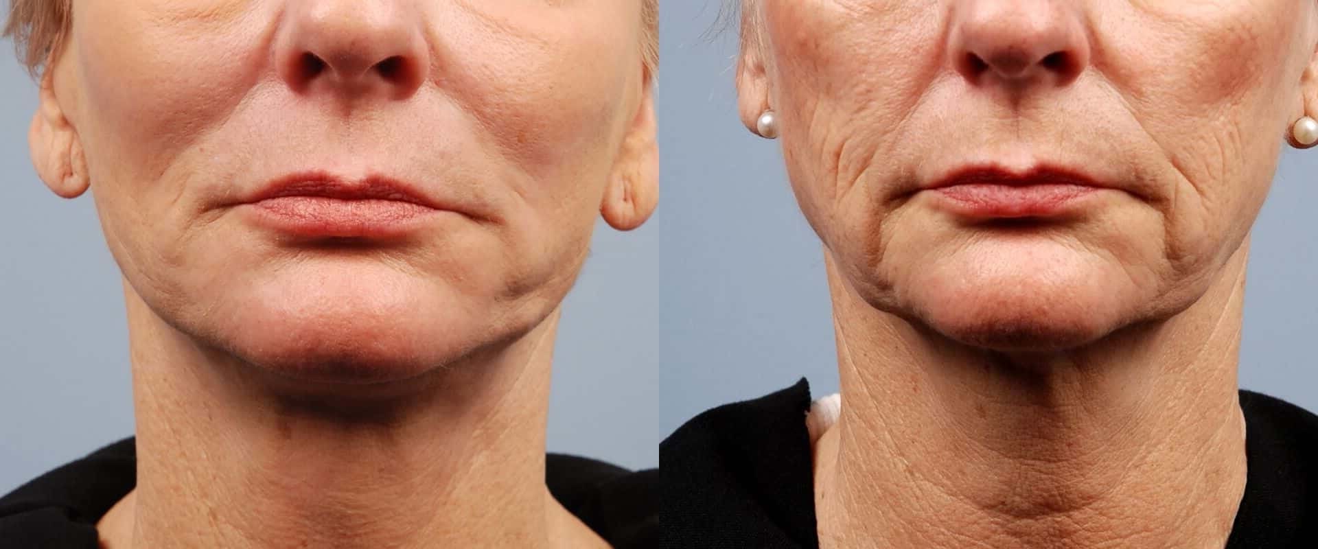 What are the Benefits of Morpheus8 Treatments?