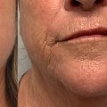 Can Morpheus8 Leave Scars? - A Comprehensive Guide