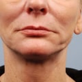 How Many Treatments of Morpheus8 Do You Need to Achieve Desired Results?
